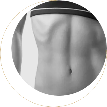  Miniabdominoplastia